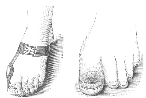 Schwarze und weiße Zeichnung eines Paares Füße, eines mit Verband und dem anderen mit einem Bruch, mit Text, der die Behandlung angibt.