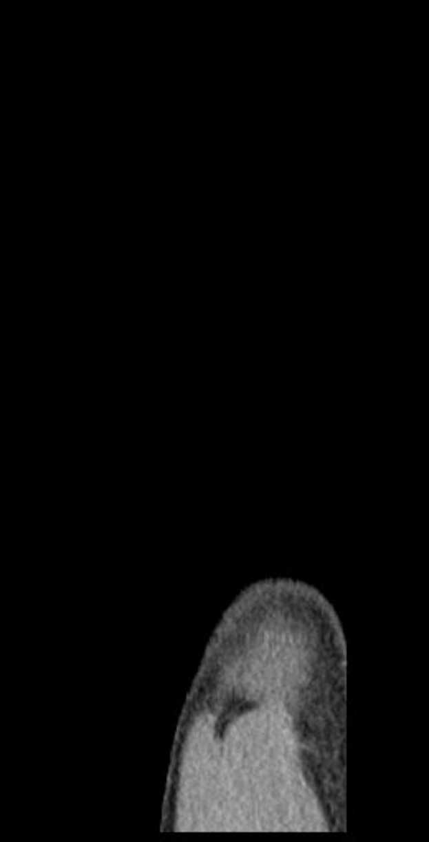 Schwarze und weiße MRI-Aufnahme eines Mannes, der einen detaillierten Blick auf das Gehirn zeigt.