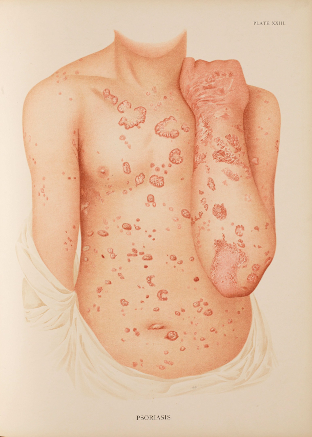 Ein Buchumschlag mit einer Illustration eines Männerkörpers mit roten Flecken, die wahrscheinlich Psoriasis darstellen, zusammen mit Text über die Erkrankung.